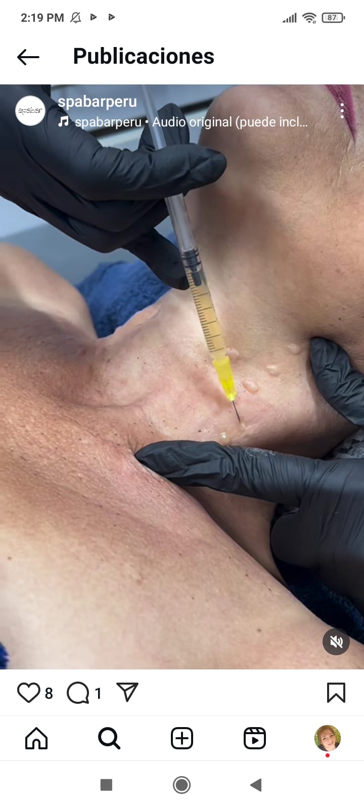 Plasma facial 2